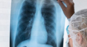 Хроническая обструктивная болезнь легких — медики предупреждают и советуют